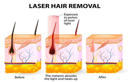 10 Myths About Laser Hair Removal Debunked: What You Really Need to Know Before Your First Session