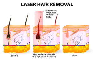 why i love laser hair removal